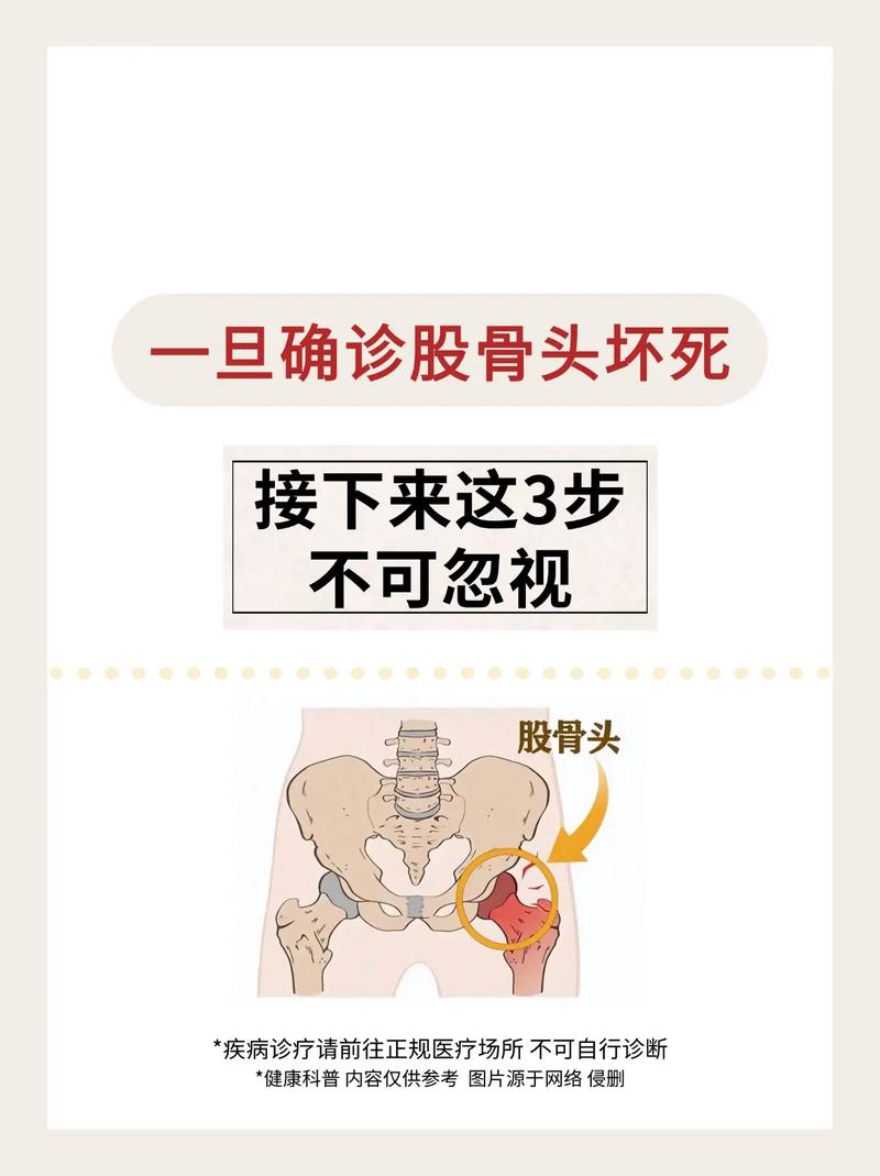 股骨头坏死的治疗费用是多少 治股骨头坏死的费用