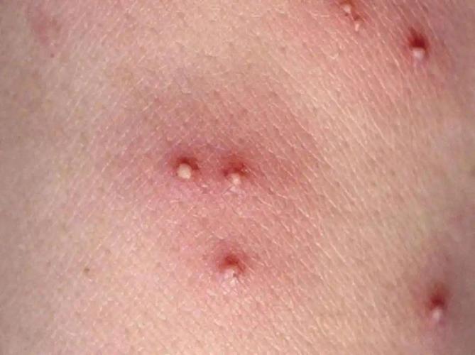 艾滋病早期皮疹特点 艾滋病初期皮疹症状