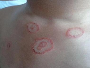 艾滋病早期皮疹特点 艾滋病初期皮疹症状